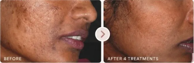 Acne scars before and after 4 microneedling treatments