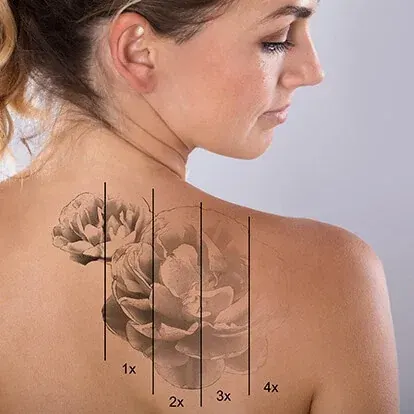 Laser tattoo removal stages