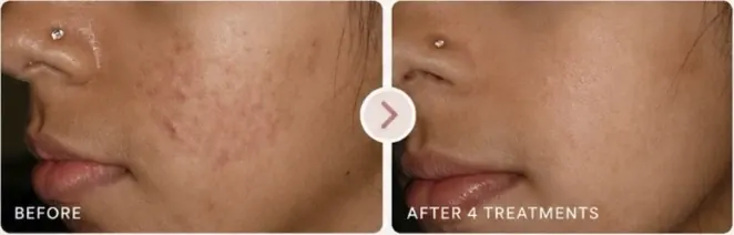 Skin texture before and after 4 microneedling treatments