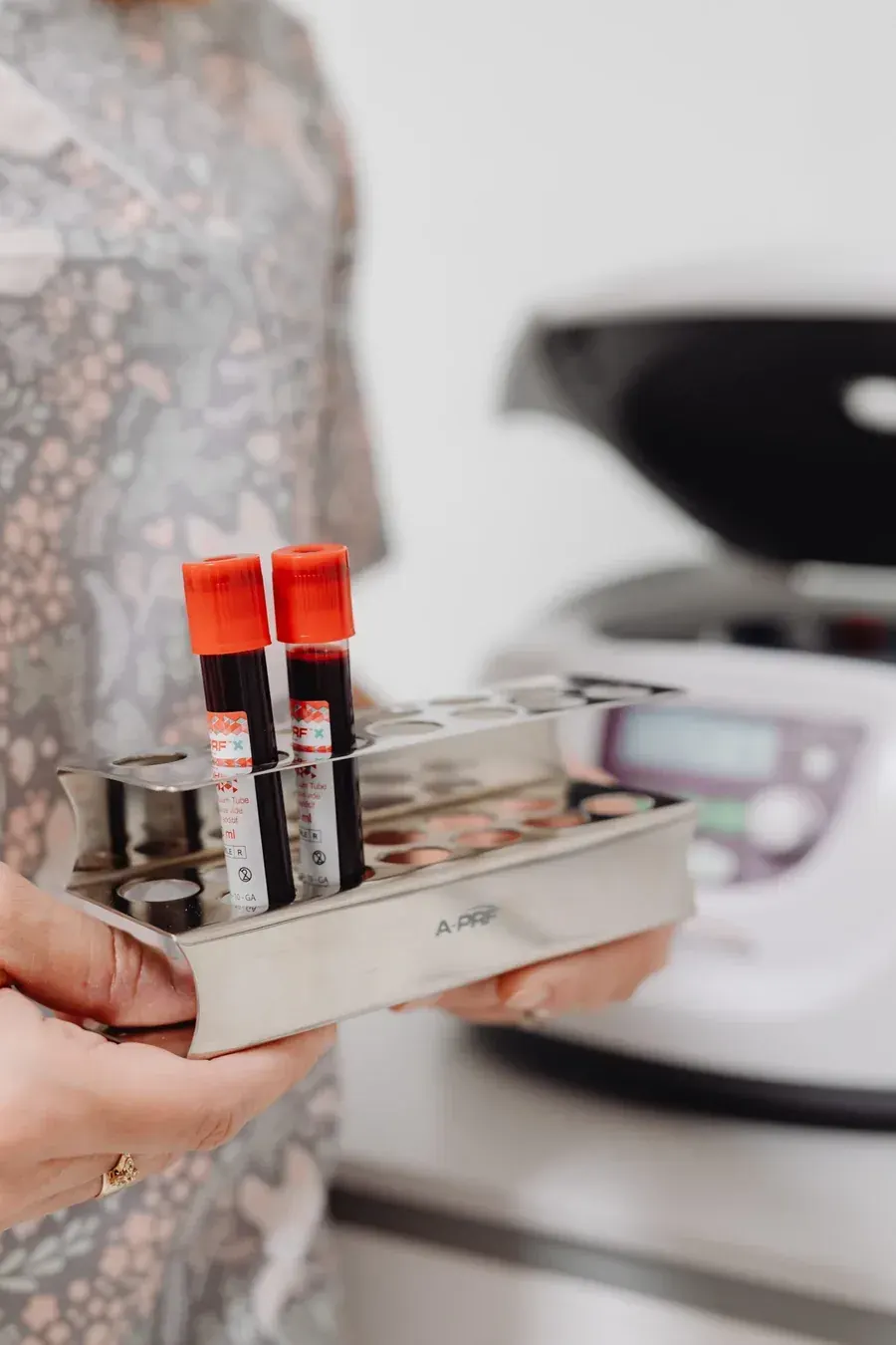 PRP treatment preparation at Elite Beauty