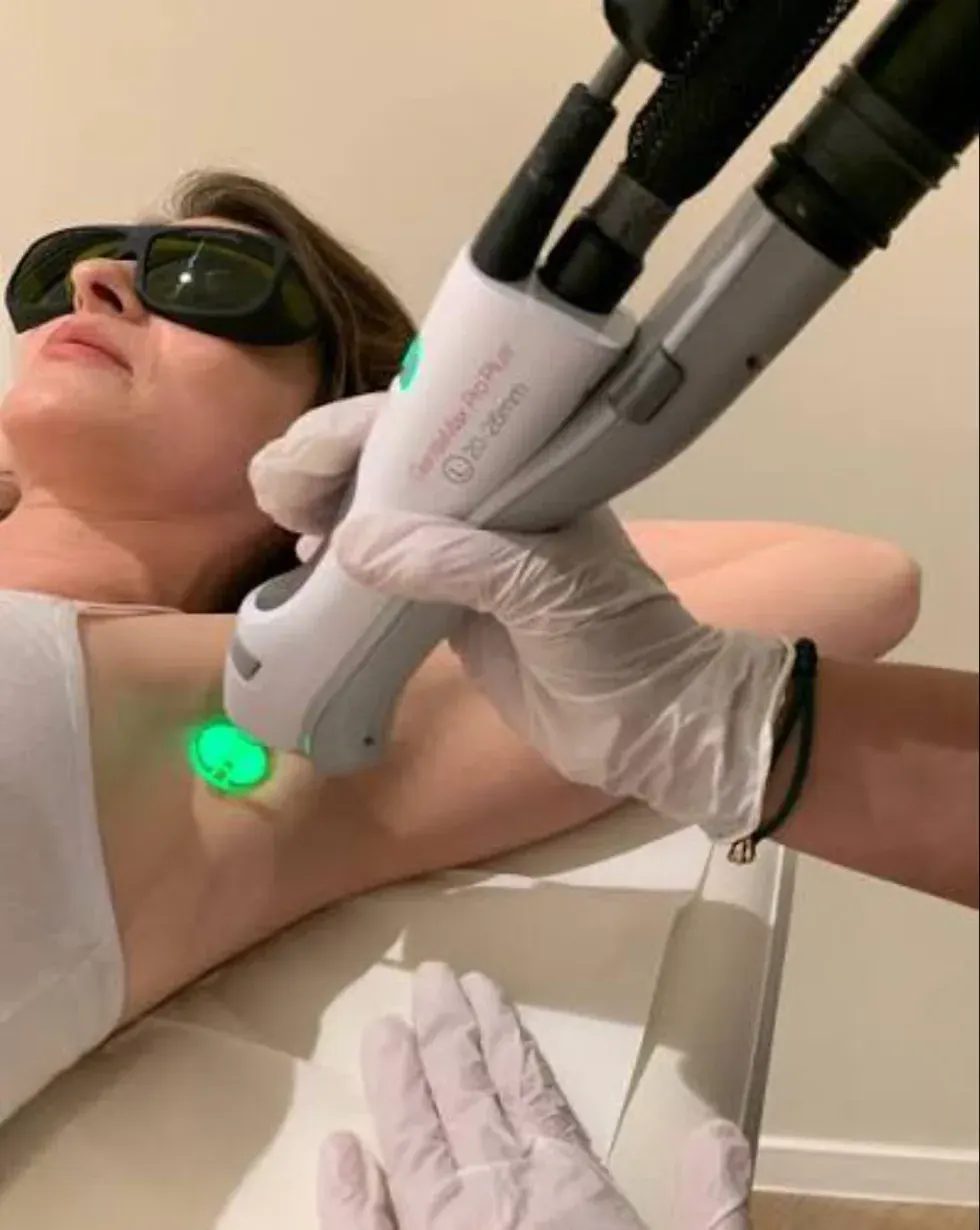 Laser hair removal with the Candela GentleMax Pro Plus